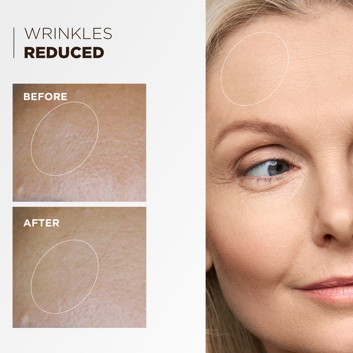 Before and after: wrinkles reduced around the eye