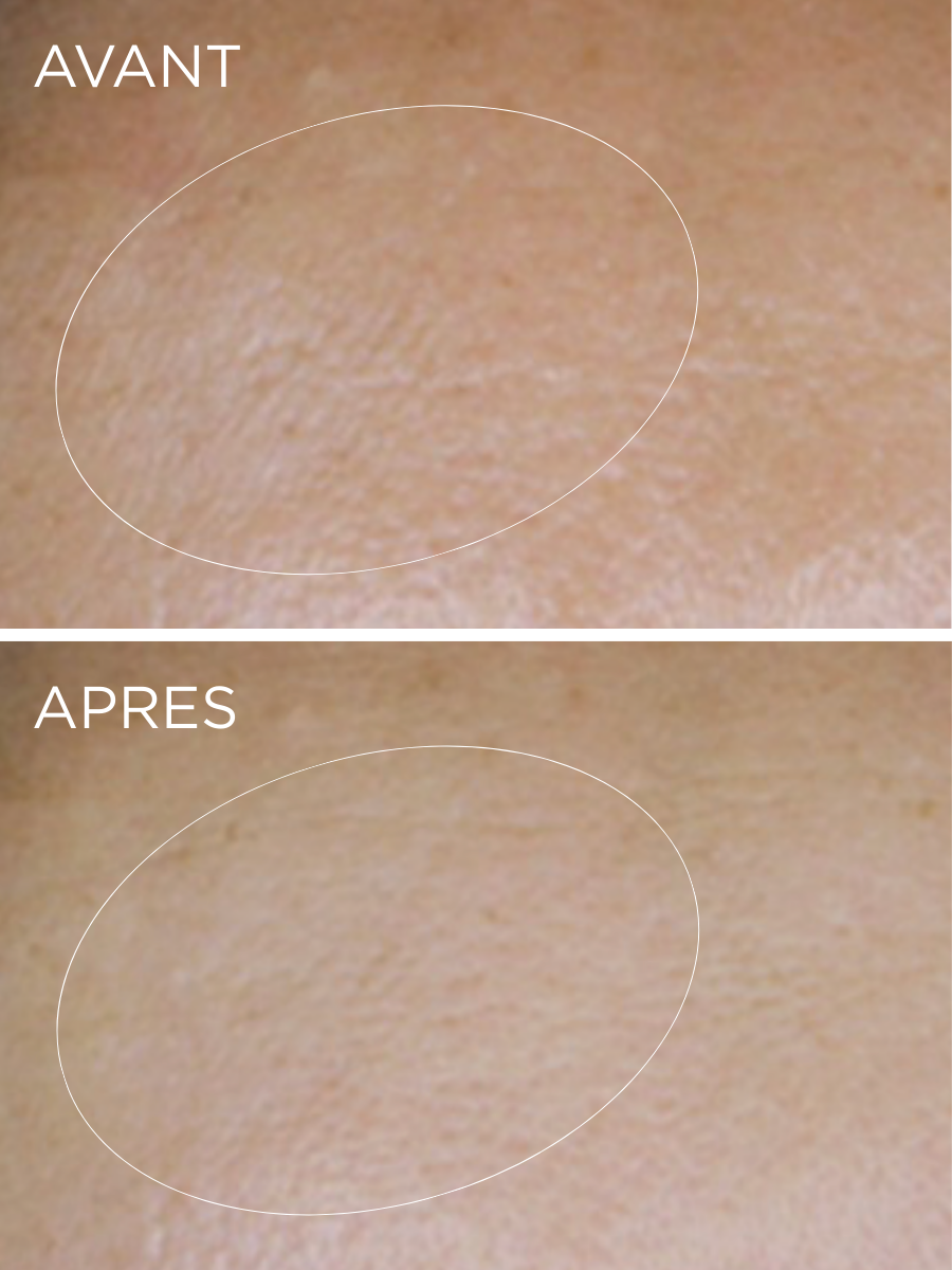Résultats cliniques de la Crème Hyaluronique HUYGENS